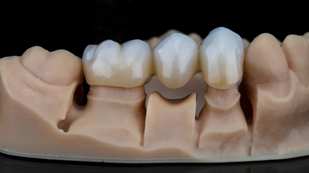 Prosthetic teeth on dental mold