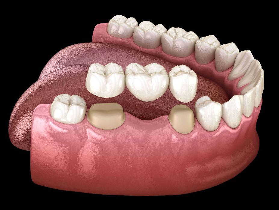 3D model of dental restoration