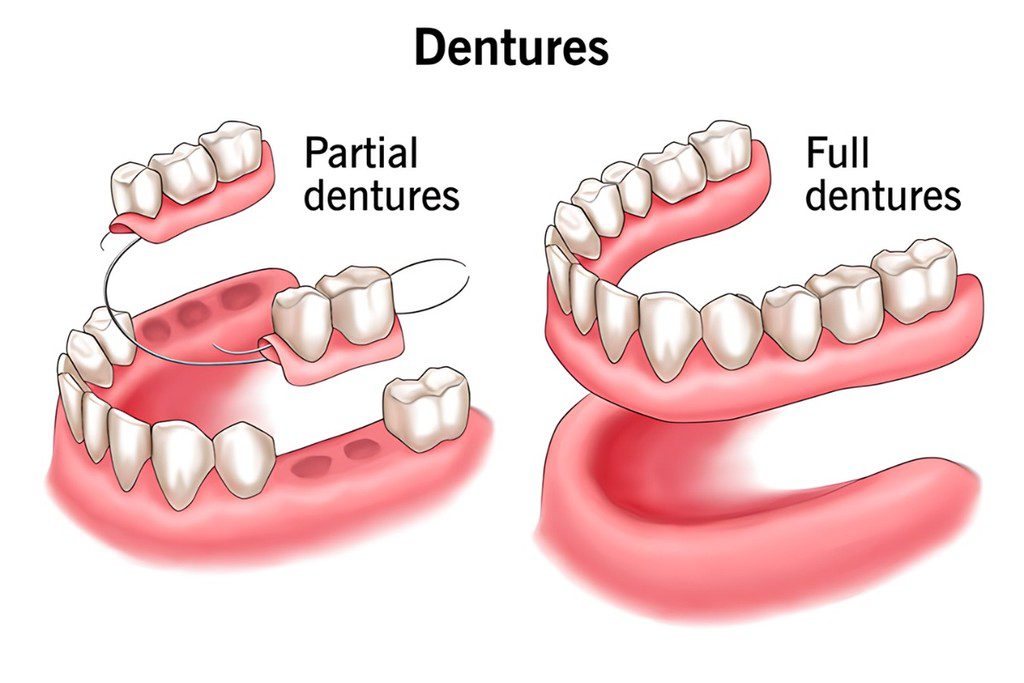 Partial and full dentures illustration