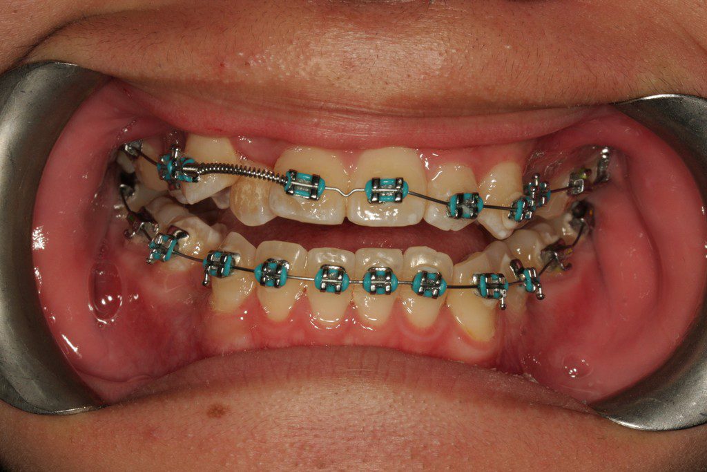 Teeth with blue braces and dental spacers