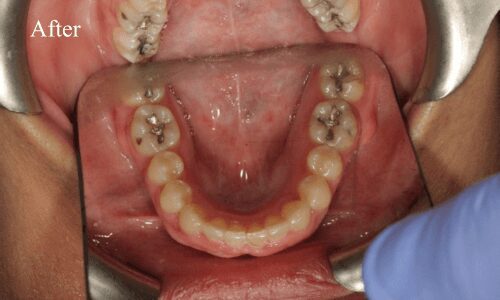 Dental procedure results, lower teeth