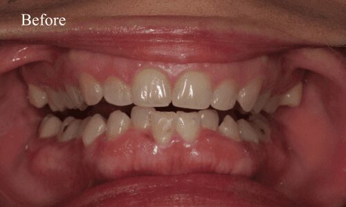 Teeth with gaps before orthodontic treatment
