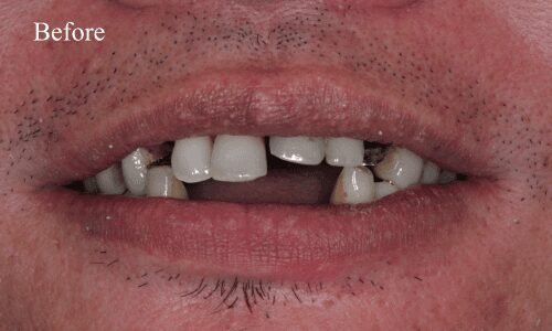 Gap and chipped teeth visible