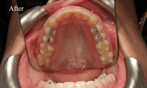 Upper teeth with dental braces