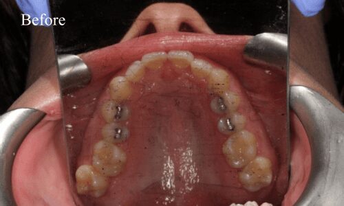 Open mouth showing upper teeth and fillings