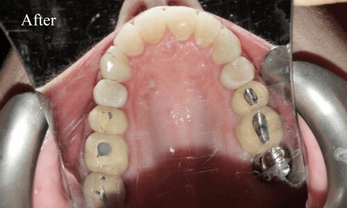 Dental implants in upper jaw