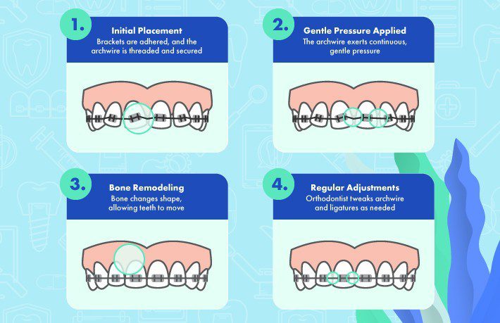 Illustration of braces adjustment stages