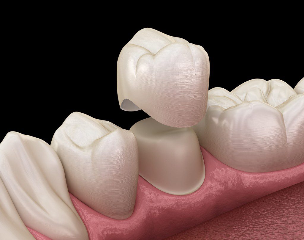 Dental crown placement illustration