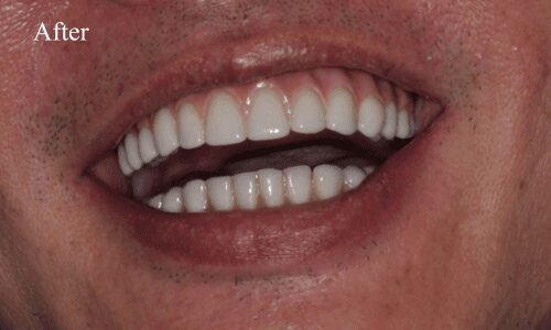 Perfectly aligned teeth after treatment