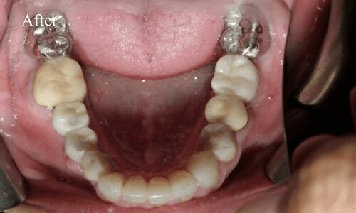 Post-treatment dental crown view