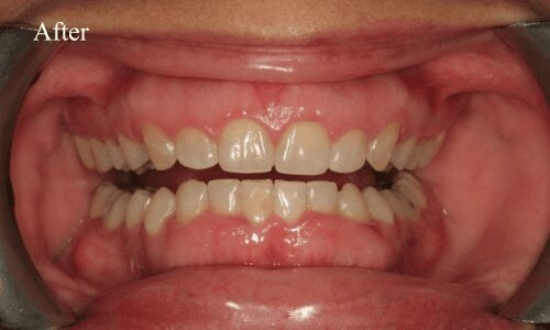 Dental alignment results