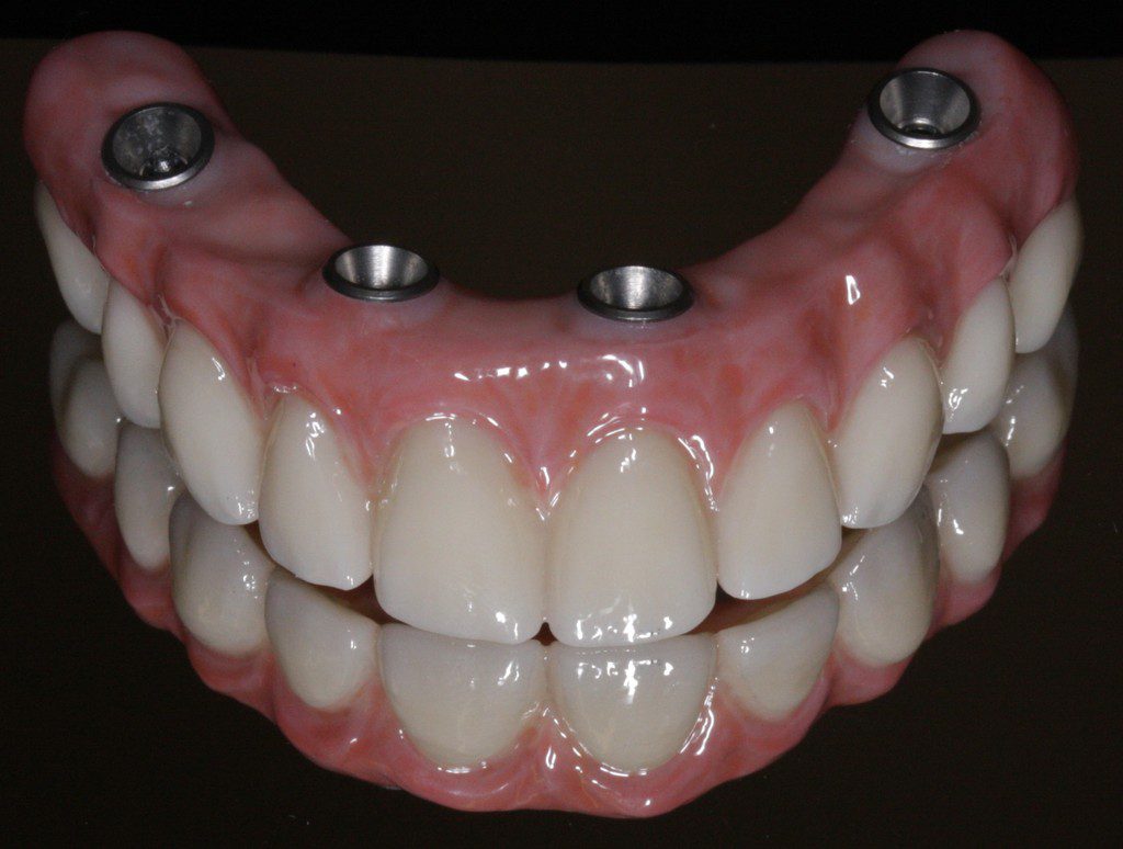 Artificial teeth set with implants