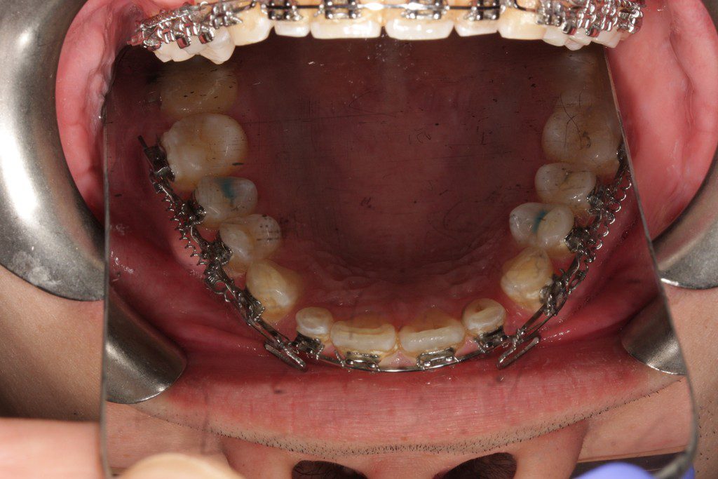 Dental braces on upper and lower teeth