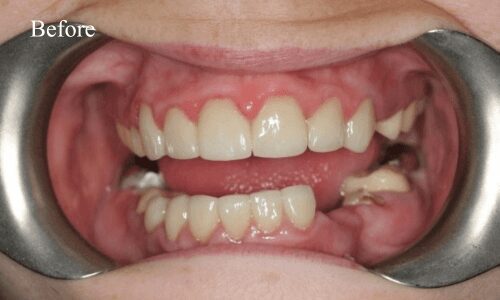 Teeth before orthodontic treatment