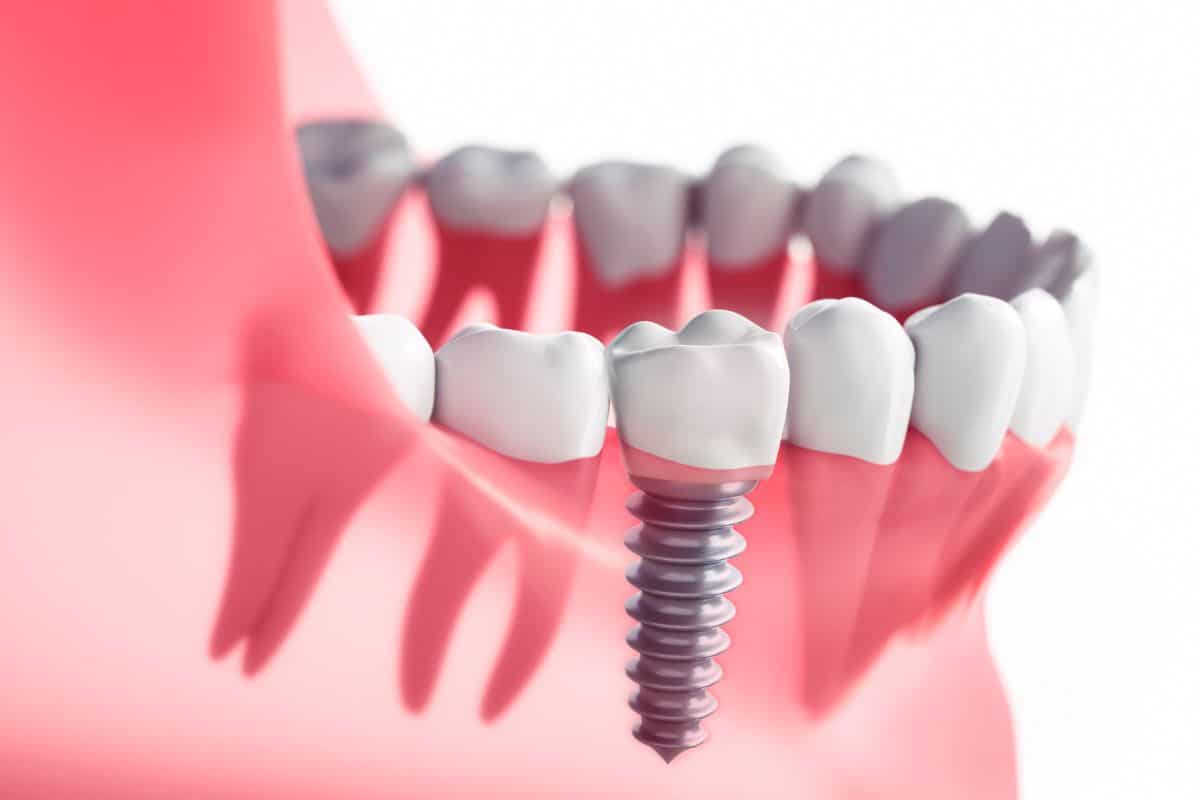 Dental implant in gums illustration