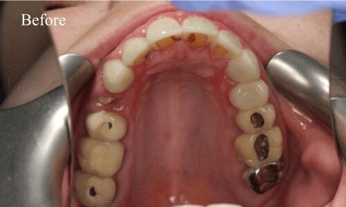 Open mouth showing dental condition